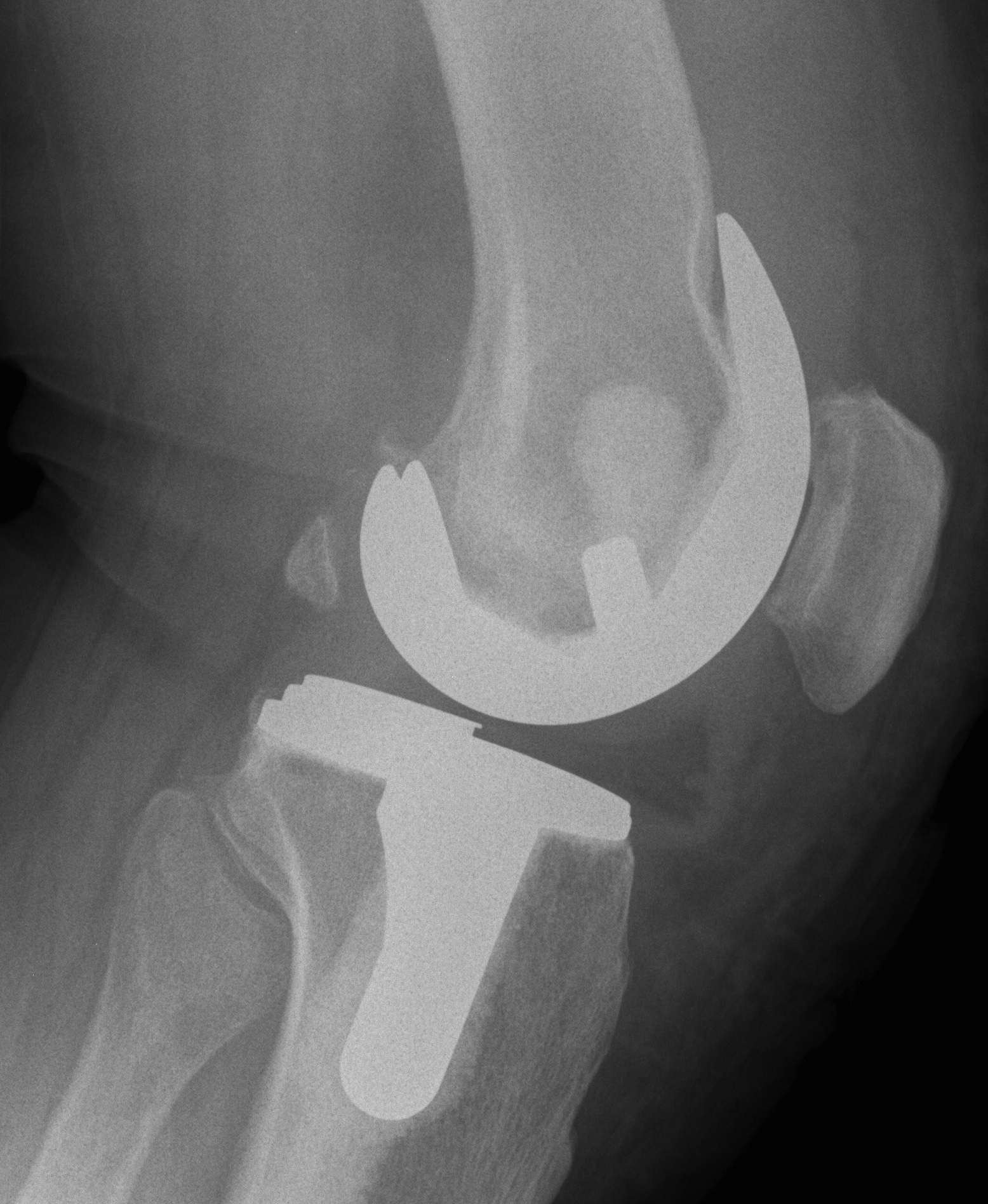 TKR Dislocated Fixed Bearing Poly